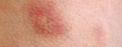 Erythema nodosum